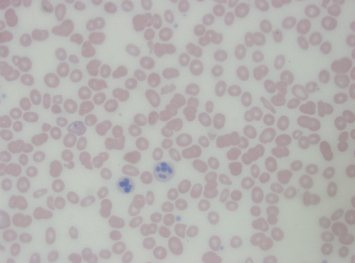 Vitamin B12 Deficiency Mimicking Thrombotic Thrombocytopenic Purpura